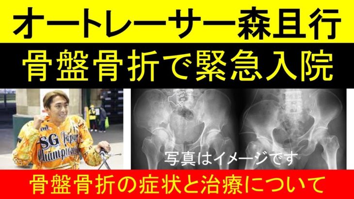 森且行(元SMAP)オートレースで骨盤骨折、骨盤骨折(寛骨臼、骨盤輪骨折)の症状、治療や手術について解説します。